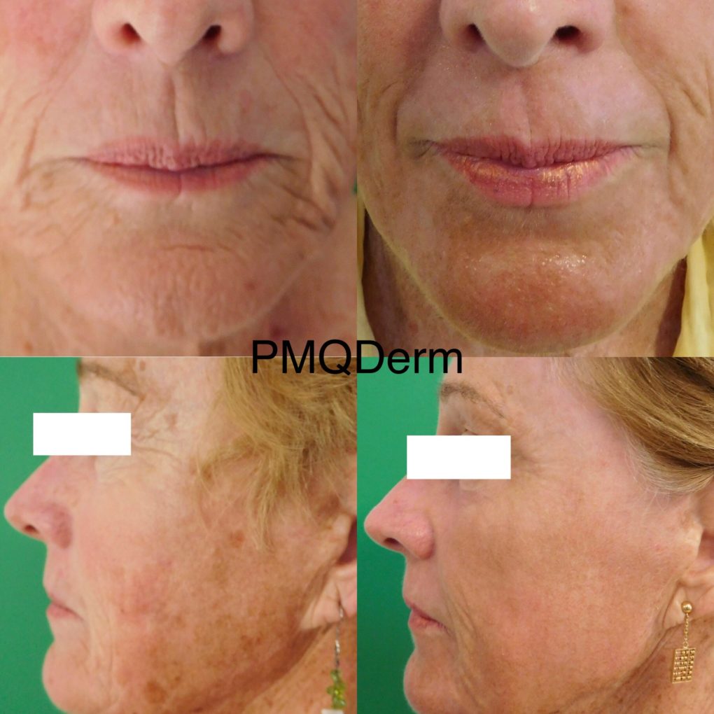 Before & After: Full field erbium resurfacing laser