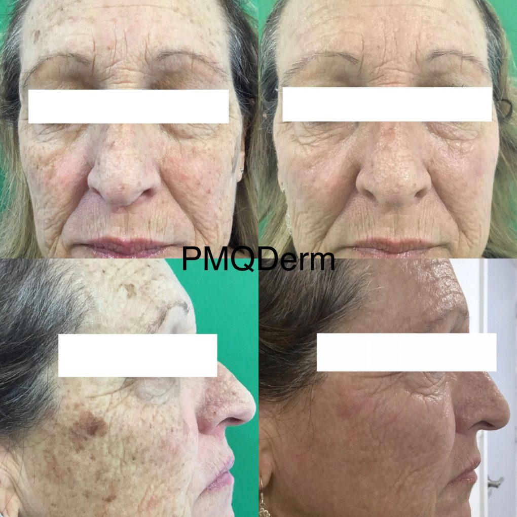 Before & After: Photodynamic therapy with BBL