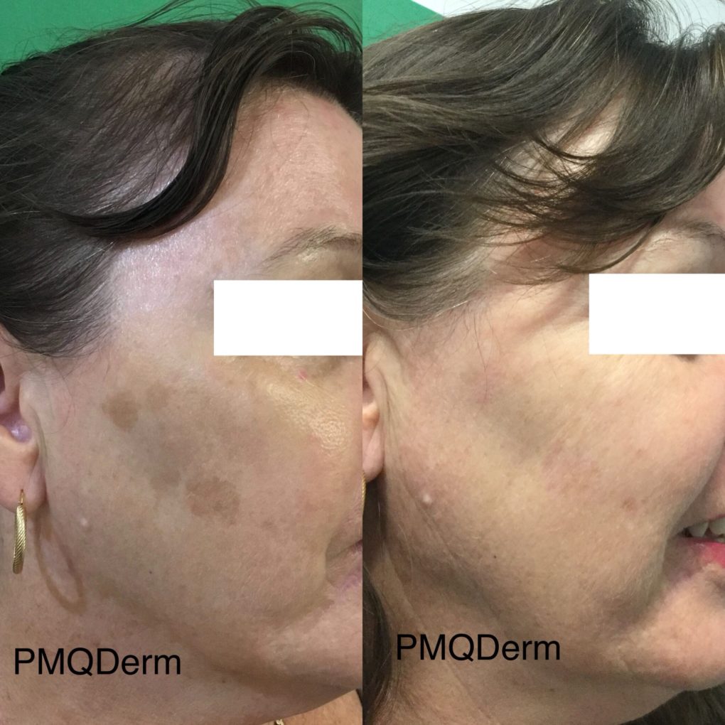 Before & After: Pastelle Q switched laser for pigmentation