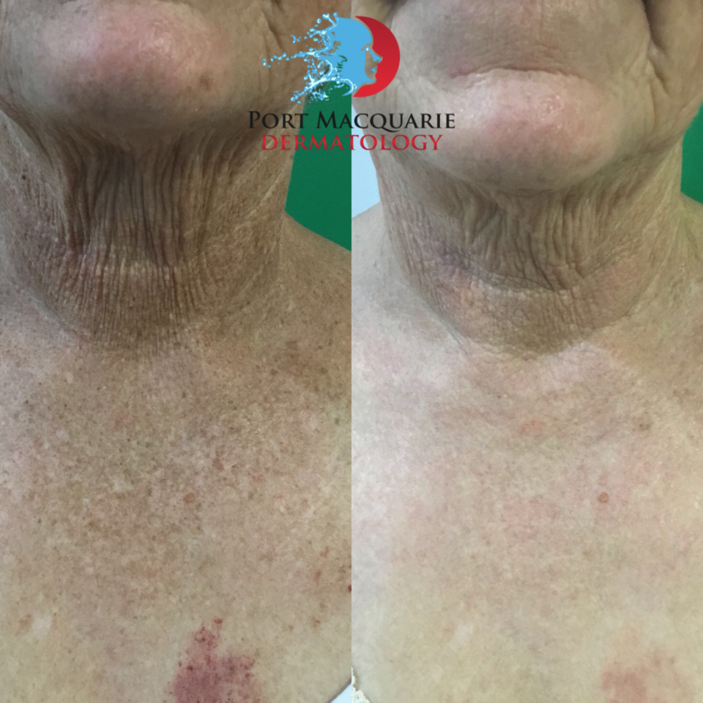 Before & After: BBL to the décolletage