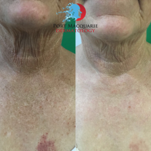 Before & After: BBL to the décolletage – Port Macquarie Dermatology