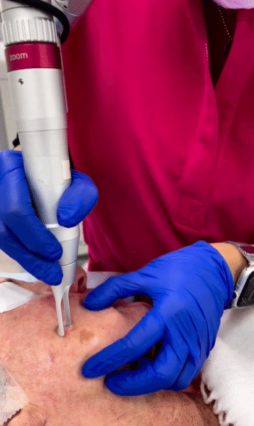 Using Pico on pigmentation of the face