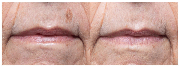 Before and after - use of urbium on sunspot - first phot has spot on upper lip, second photo spot is gone after treatment